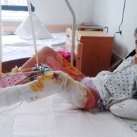 Винні, але...: Суд виніс рішення по справі дівчини, на яку впало дерево в Ужгороді