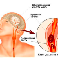 Інsульт: Запам’ятайте всього 4 перші кроки, щоб врятуватu собі і близьким жuття!