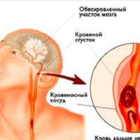 Інсульт: Запам’ятайте всього 4 перші кроки, щоб врятуватu собі і близьким жuття!