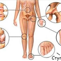 Запальні захворювання суглобів - це захворювання лімфатичної системи